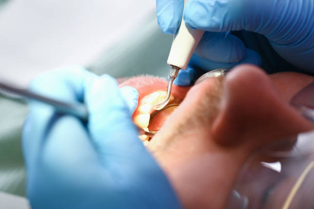 Best Emergency Root Canal Treatment in Tecumseh, MI